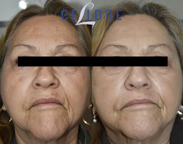 Witness the before-and-after of laser treatment for brown spots on Hispanic skin, revealing a clearer, more even-toned complexion.