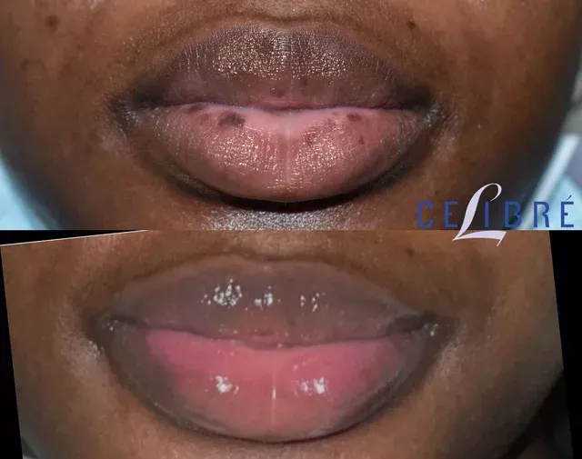 African-skin-lip-spot-removal-before-after-lasers shows smoother, clearer lips with effective dark spot reduction.
