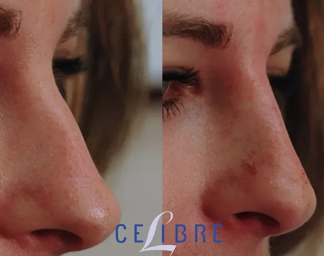 Check Radiesse-for-nose-filler-photos-jpg to see impressive before-and-after results for a refined nose