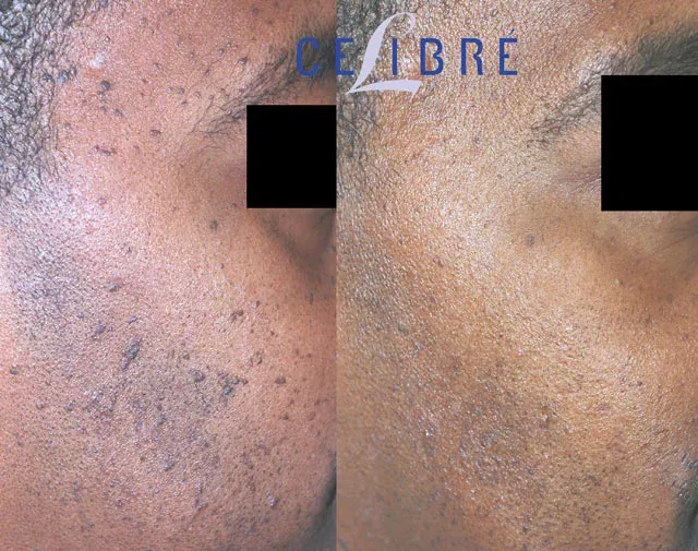 African-American-mole-removal-before-after shows clear, smooth skin with safe and effective mole removal results.