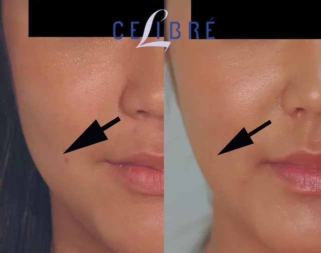 Achieve a slimmer, contoured look with asian-masseter-reduction-before-after results