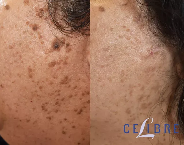 Achieve clear, smooth skin with bumpy-brown-spot-removal-asian-skin for a flawless complexion