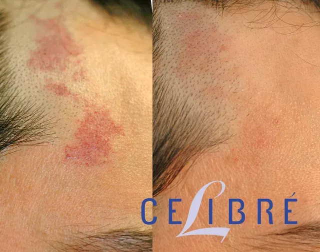 Learn safe and effective ways on how-to-remove-red-birthmark naturally and medically