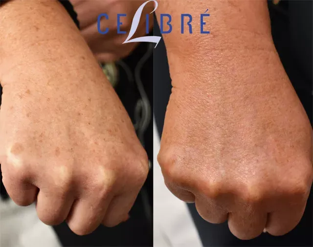Dermal-filler-for-hand-rejuvenation-before-after shows smoother, fuller hands with a youthful, refreshed look