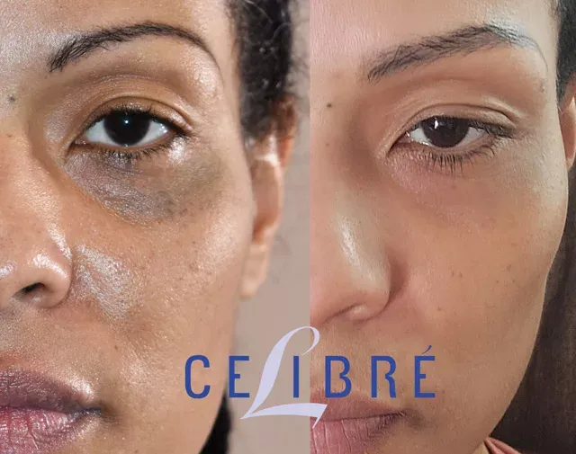 African-american-skin-nevus-of-ota-laser-removal shows noticeable lightening and smoother, even-toned skin.