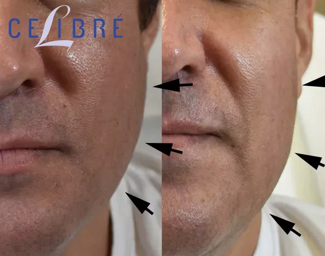 Relieve tension and reshape your look with Masseter-reduction-for-TMJ-before-after results