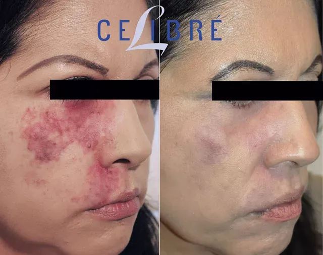 Can-Port-wine-birthmarks-be-removad? Learn how laser treatments can effectively reduce their appearance