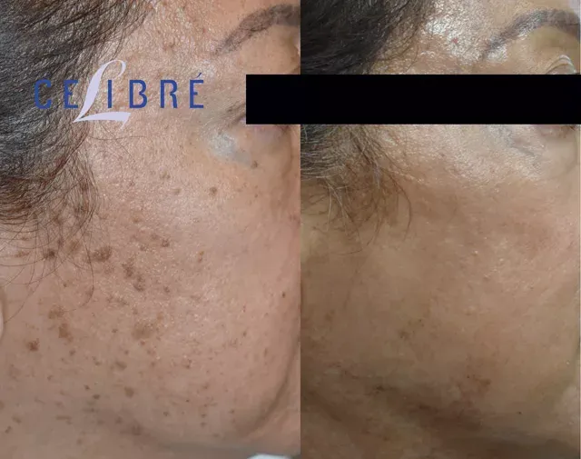 See real results of cauterize-flat-moles-in-asian-skin-before-after for smooth, flawless skin