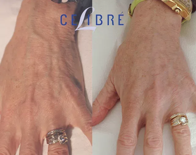 Dermal-filler-for-hand-rejuvenation-before-after shows plumper, smoother hands with restored youthful appearance.