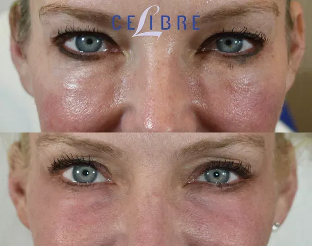 See natural results with dissolve-juvederm-filler-before-after treatment