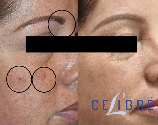Mole-removal-before-after-with-hyfrecator shows clear, smooth skin with safe and effective treatment results.