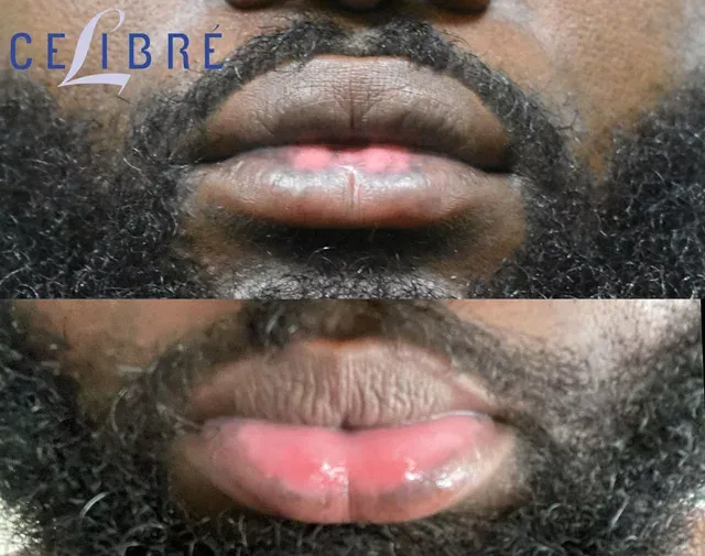 Remove-dark-spots-on-lip-laser-before-and-after shows clearer, even-toned lips with effective spot reduction.