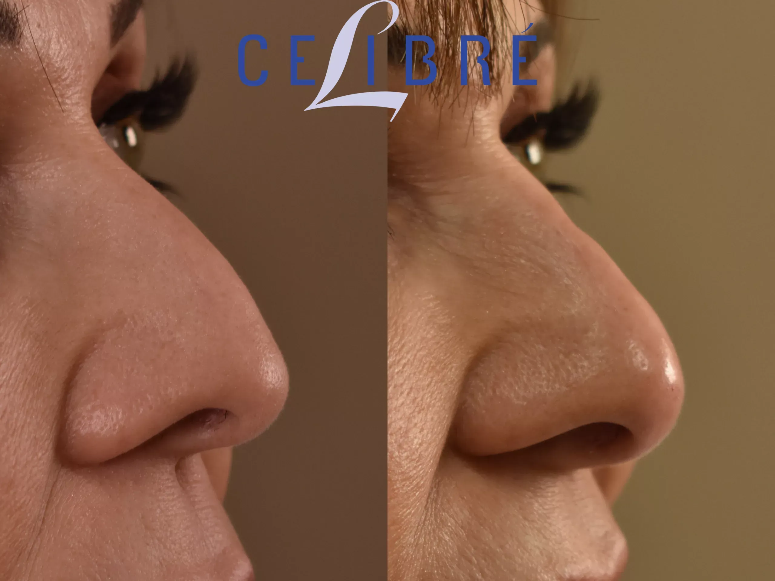 Explore which-filler-for-nose-injections-scaled to achieve safe, precise, and natural-looking nose enhancements