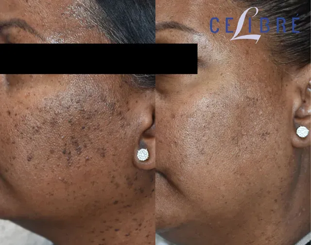DPN-mole-removal-dark-skin-bef shows noticeable mole removal and smoother, clearer skin.