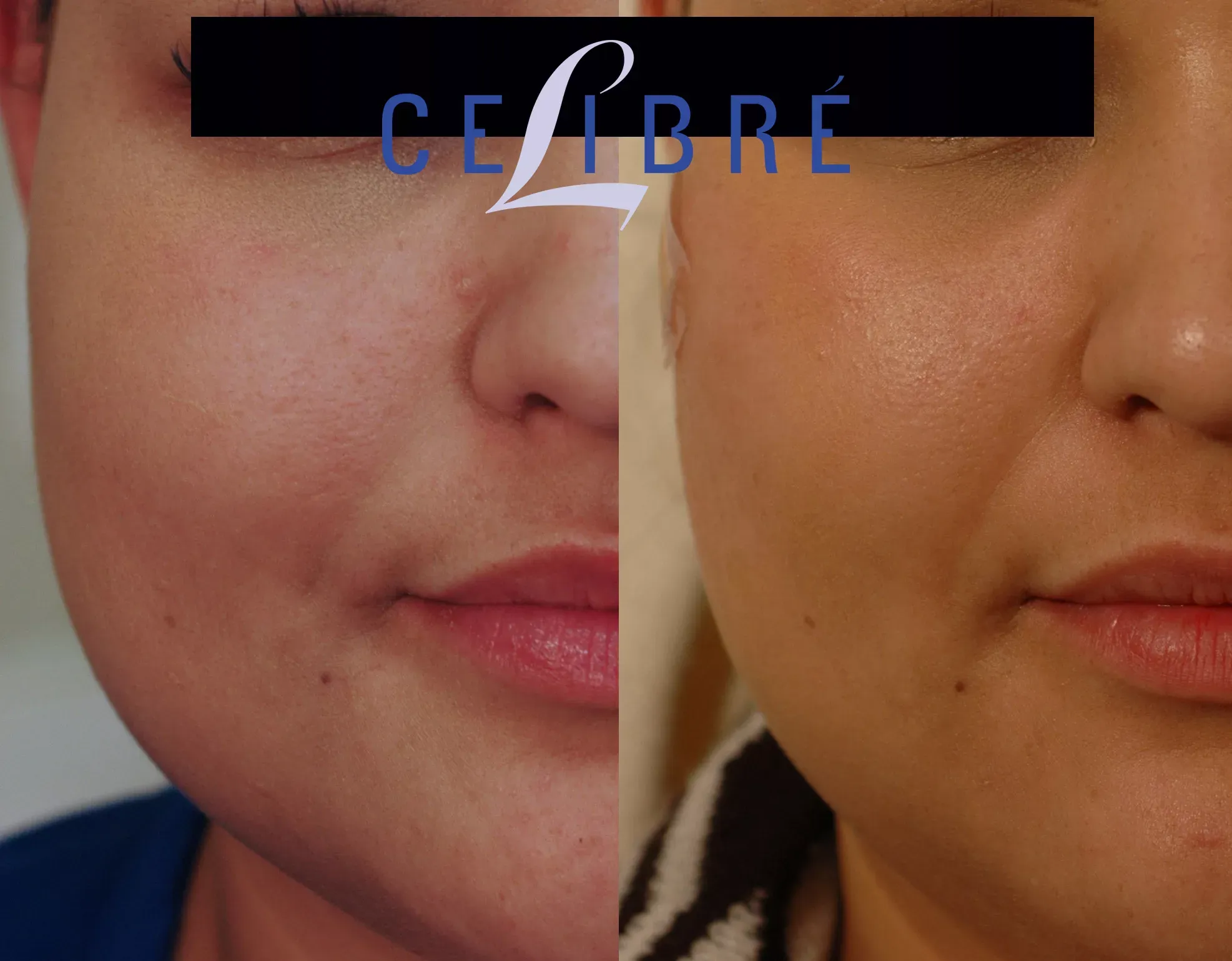 Find relief and balance with botox-for-teeth-grinding-migraines-before-after results