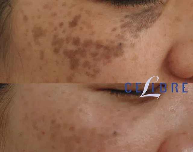 Transform your look with brown-birthmark-laser-removal-asian-skin for smoother, clearer skin