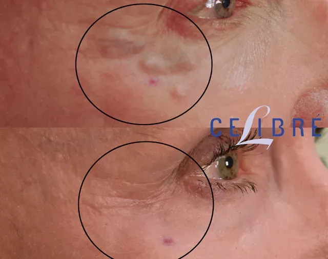 dissolving-juvederm-around-the-eyes-before-after