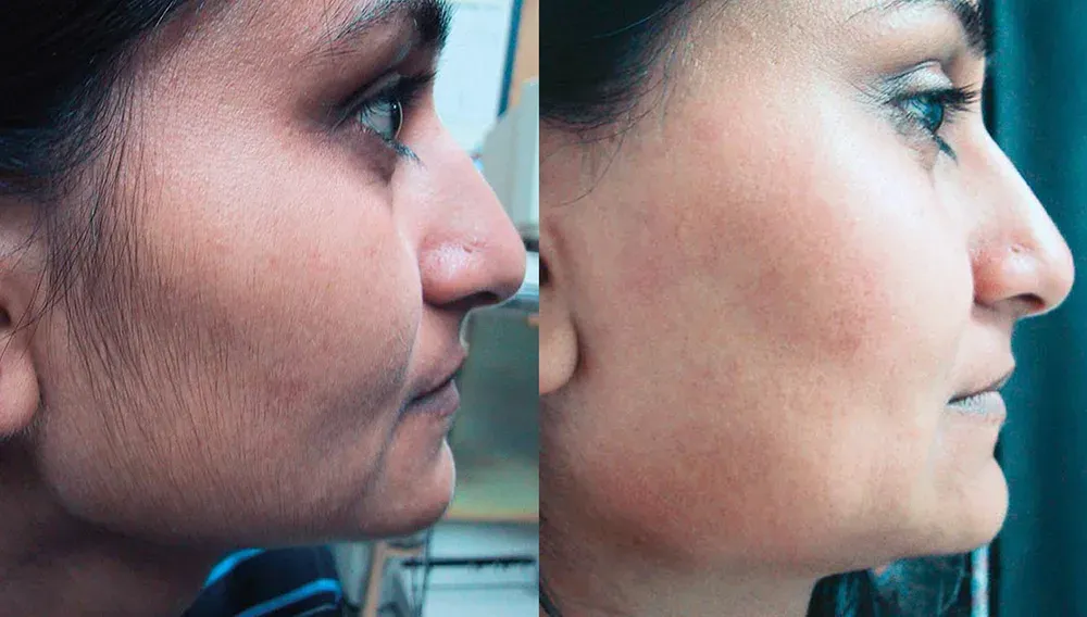 PCOD Patients with laser hair removal