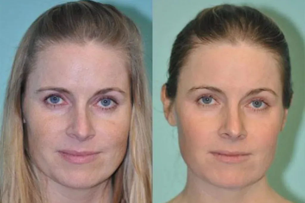 Erbium Laser Resurfacing