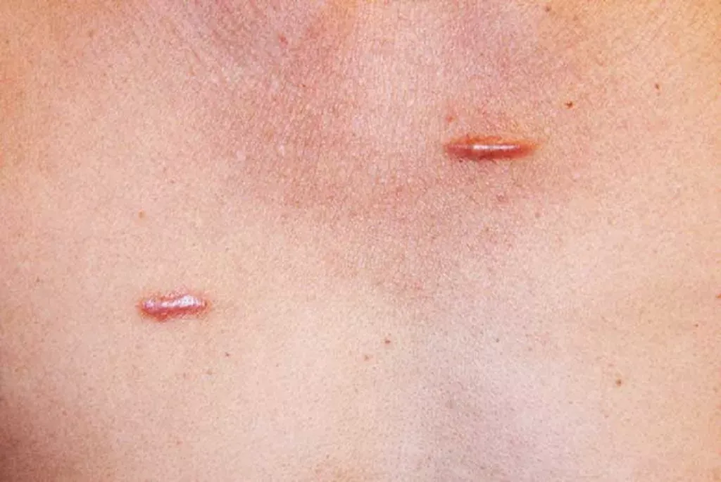Keloid Scar