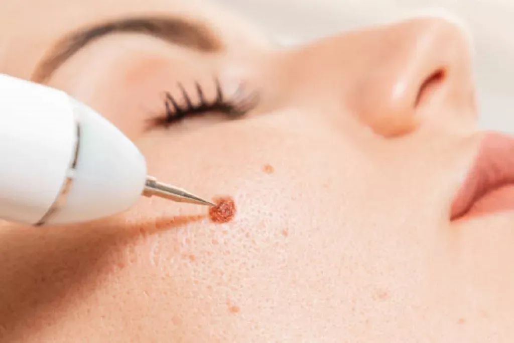 Laser Treatment for Wart Removal