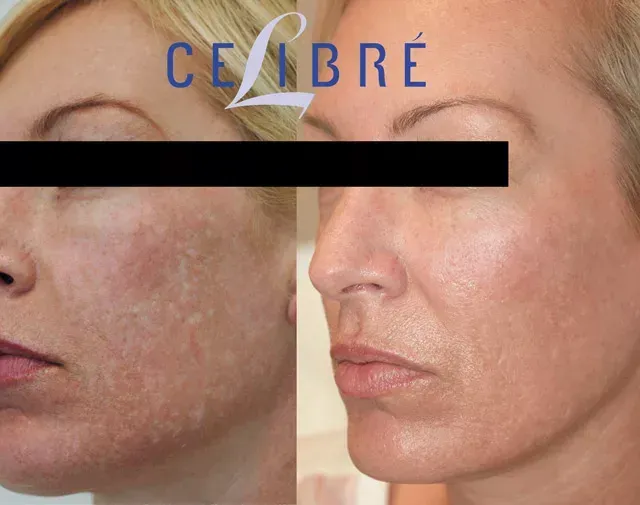 Laser resurfacing before and after