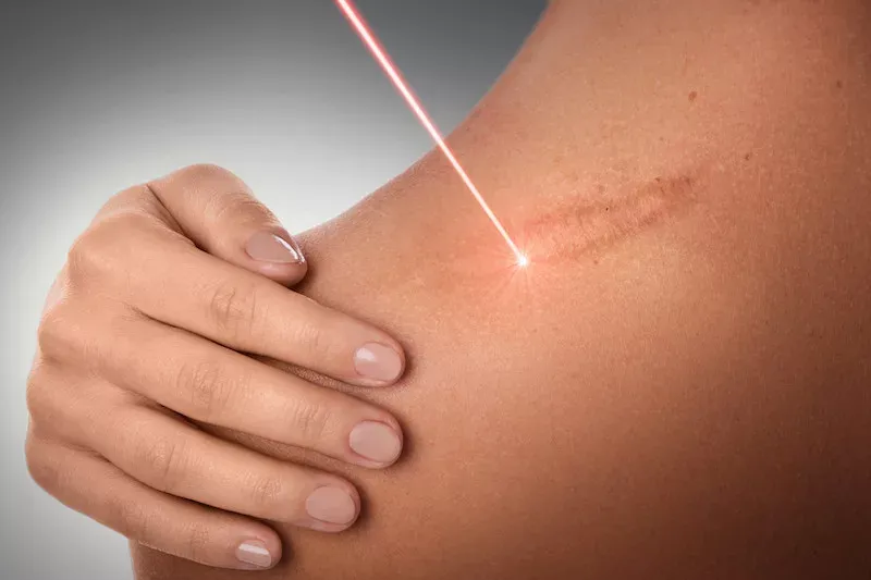 Laser stretch marks