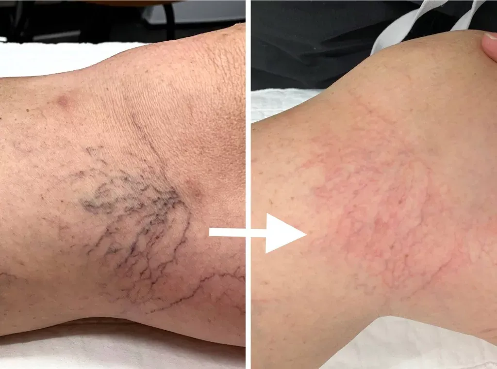 Lasers for Spider Veins