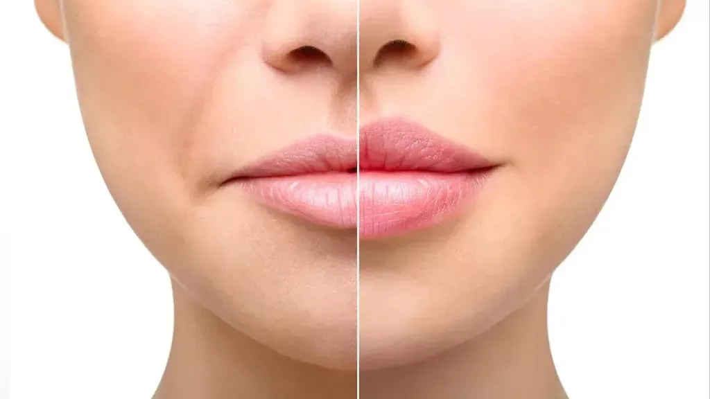 Mouth and Lip Augmentation