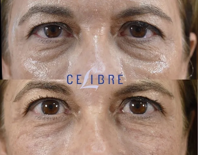Restylane-upneeq-for-eyes-before-after: enhancing eye lift and brightness with natural-looking results