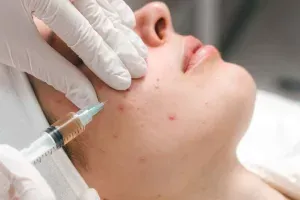 Steroid Injections for Acne