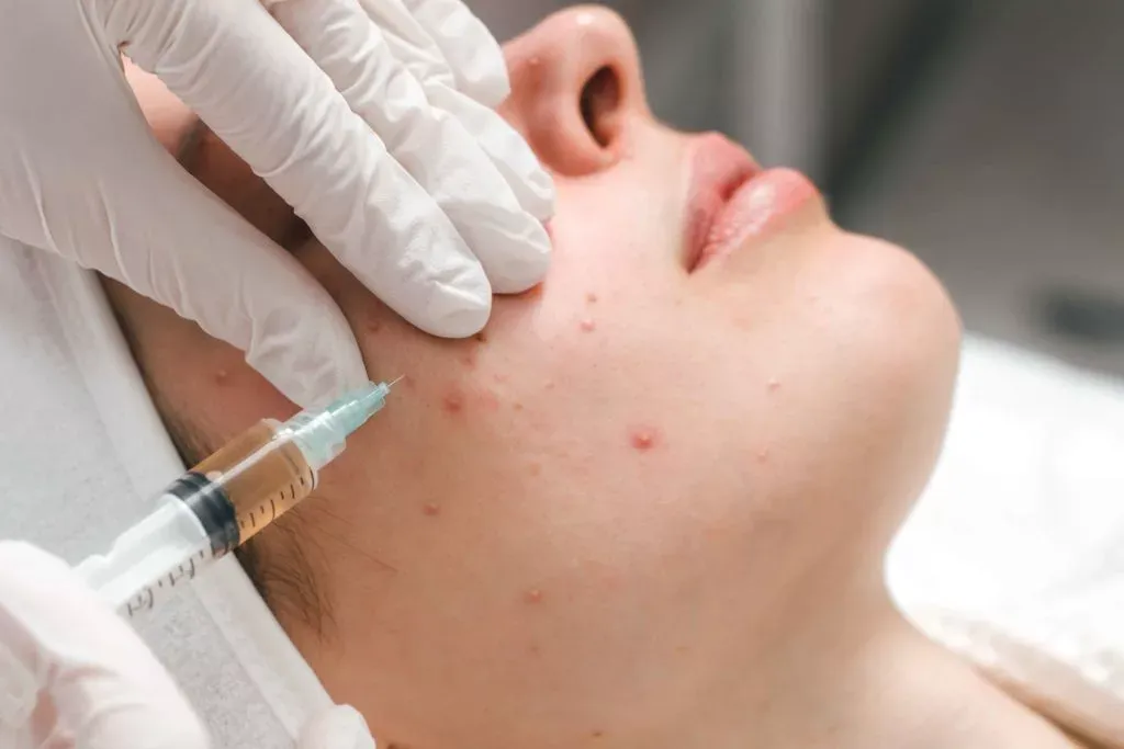 Steroid Injections for Acne