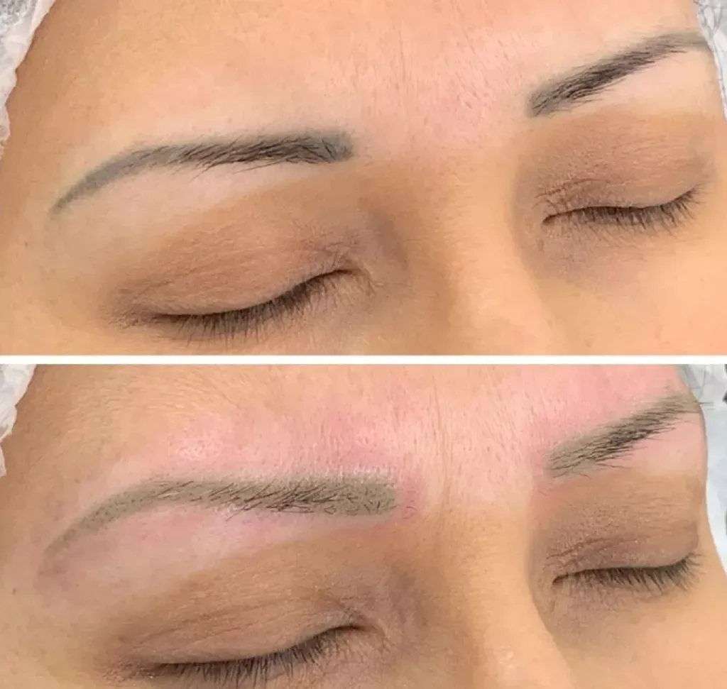 Tattoo and permanent makeup removal
