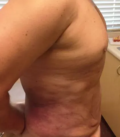 VaserLipo