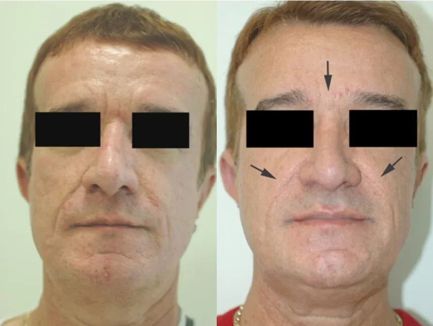 best treatment for orange peel skin