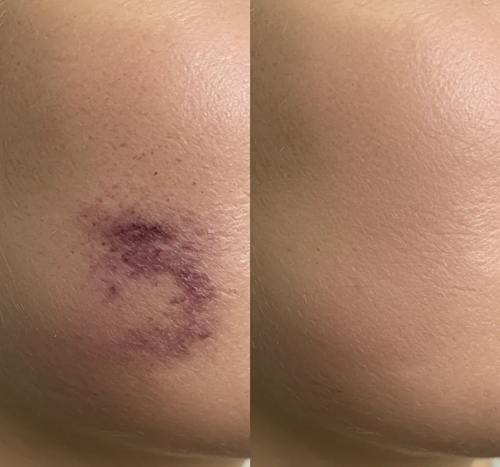 bruise before after