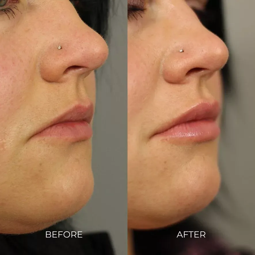 dermal filler injections