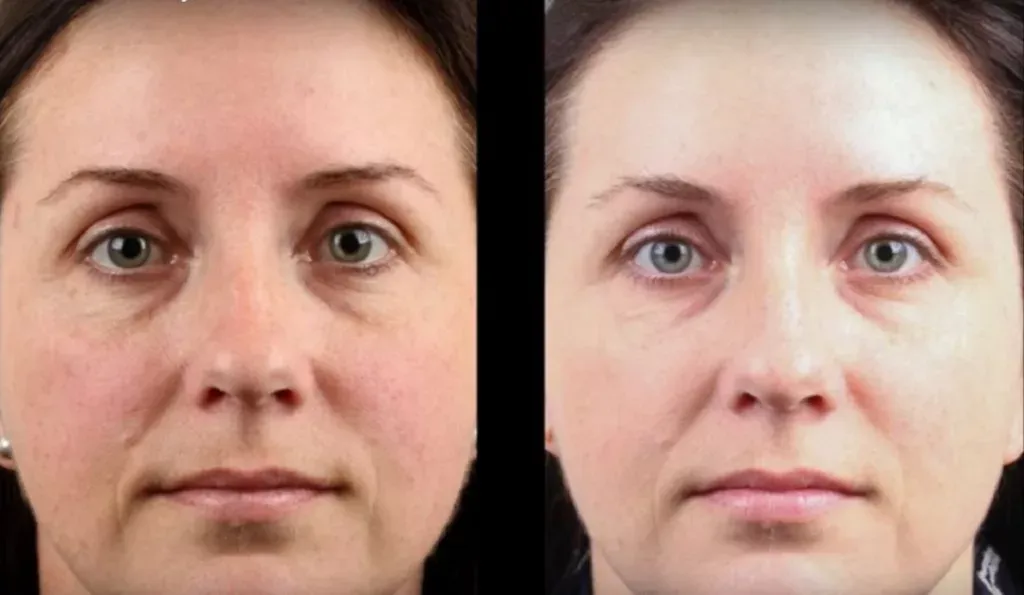 freckles laser treatment