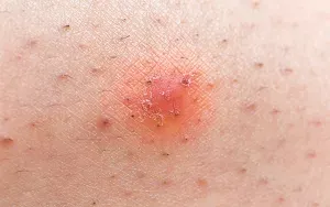 Get Rid of Ingrown Hair