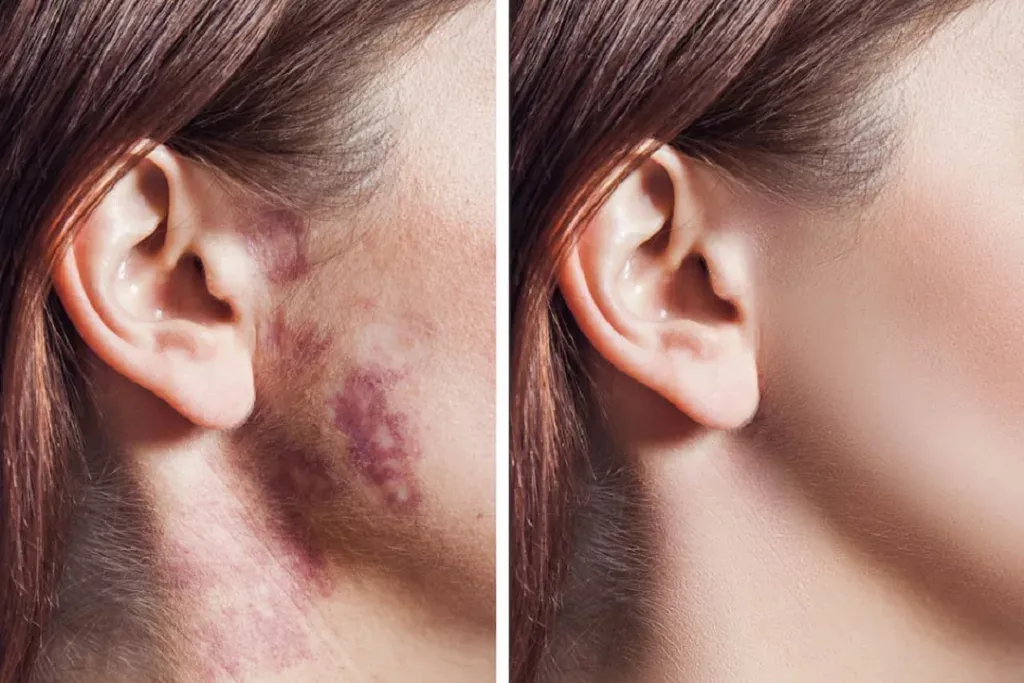 laser for birthmark removal