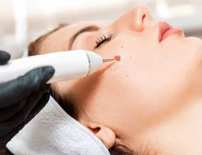 removing birthmarks