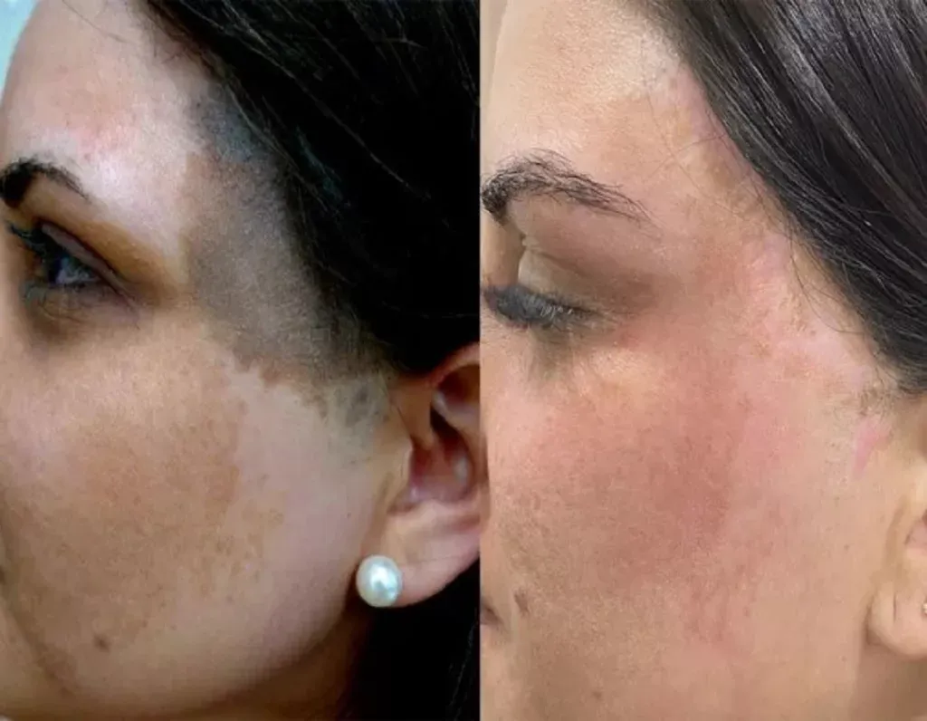 ota birthmark