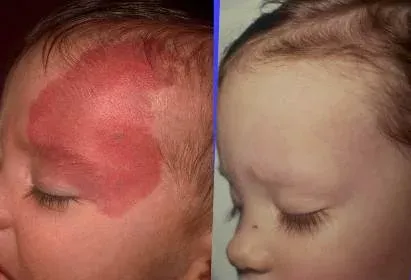 port wine stain birthmark