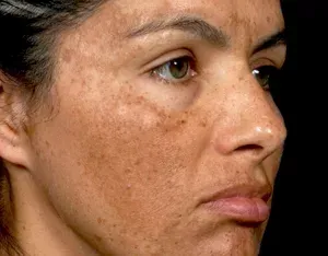 what's melasma